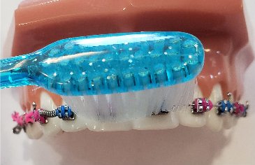 How to brush on top of braces