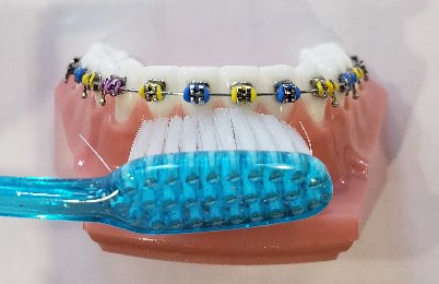 Brushing teeth and gums wearing colorful braces in Spokane, WA