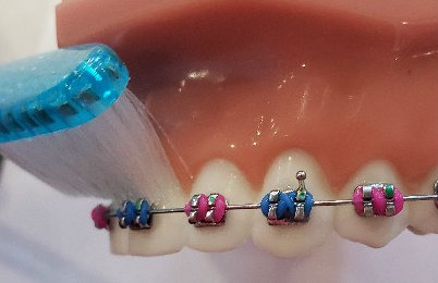 Brushing teeth above the braces