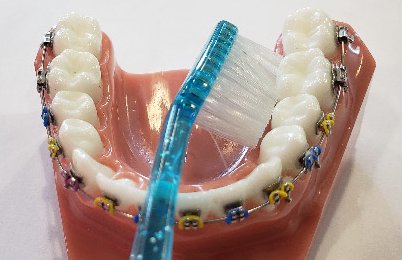Brushing teeth behind braces