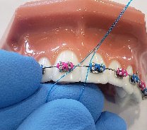Flossing in-between braces by Spokane, WA dental professionals
