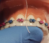 Dentist flossing colorful braces in Spokane, WA